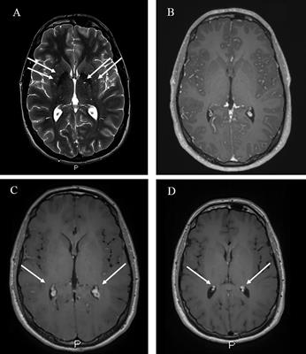 Cryptococcal Meningitis and Post-Infectious Inflammatory Response Syndrome in a Patient With X-Linked Hyper IgM Syndrome: A Case Report and Review of the Literature